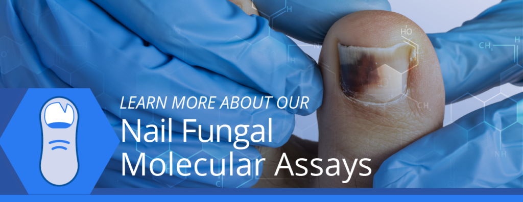 Nail fungal molecular assays developed by DTPM